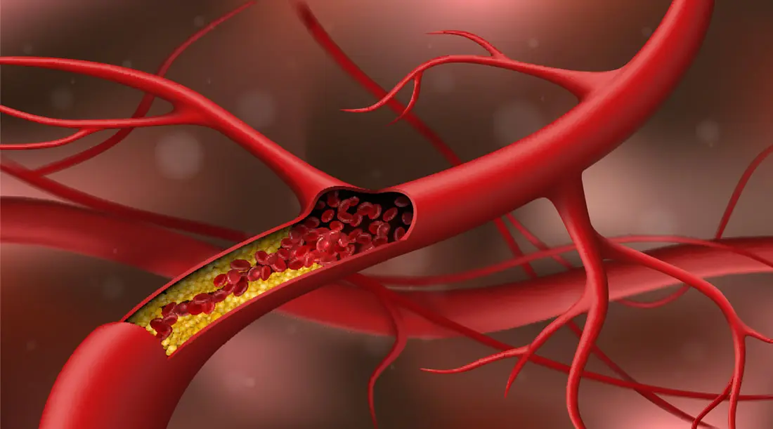 5 bệnh do cholesterol cao 